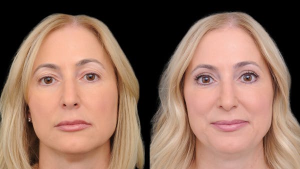 Upper Eyelid Surgery Before & After Gallery - Patient 152989 - Image 1