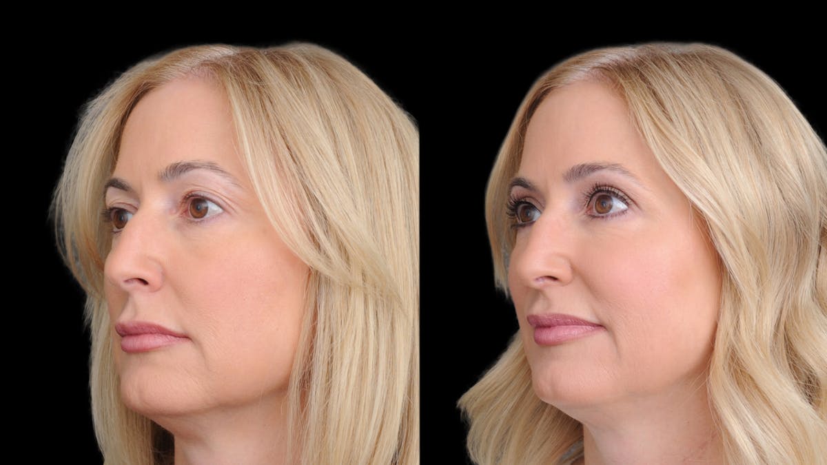 Upper Eyelid Surgery Before & After Gallery - Patient 152989 - Image 2