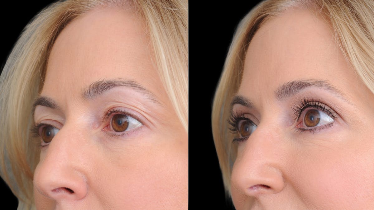 Upper Eyelid Surgery Before & After Gallery - Patient 152989 - Image 3