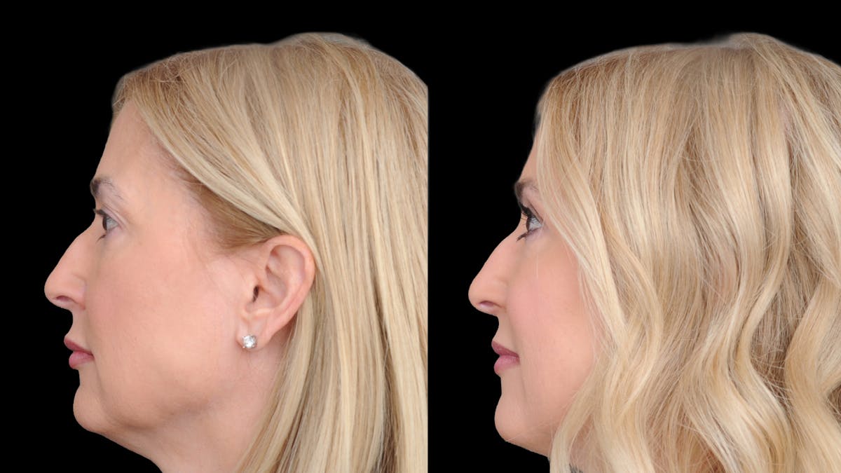 Upper Eyelid Surgery Before & After Gallery - Patient 152989 - Image 4