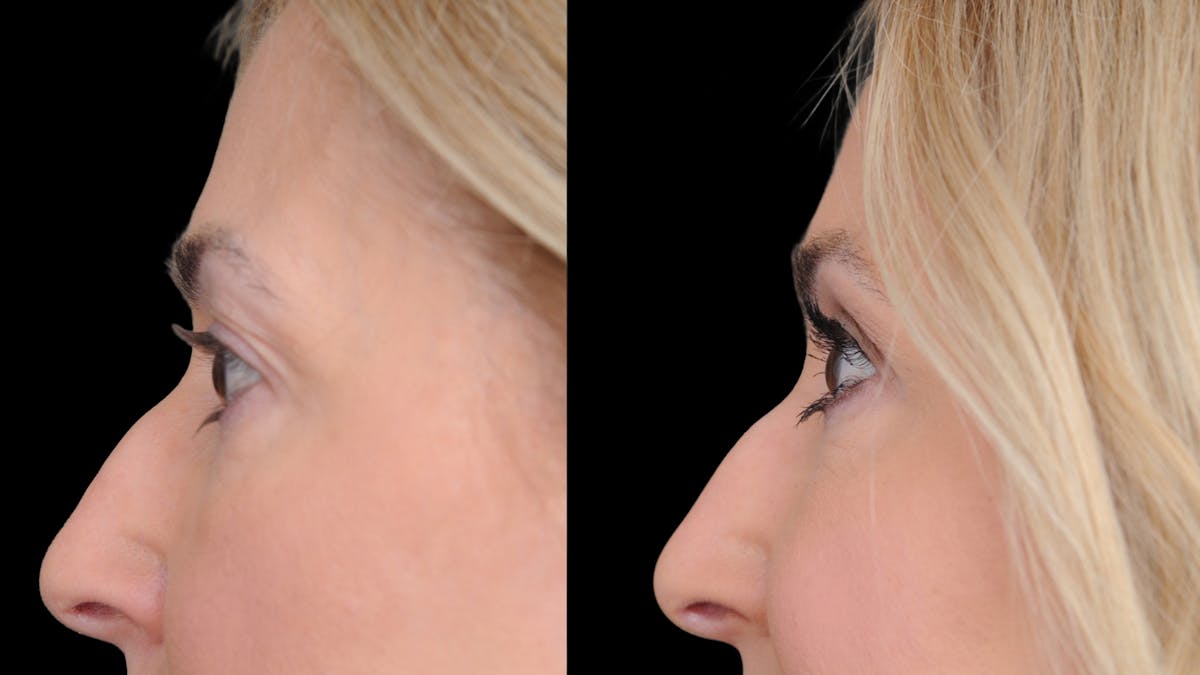 Upper Eyelid Surgery Before & After Gallery - Patient 152989 - Image 5