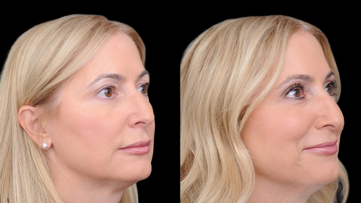 Upper Eyelid Surgery Before & After Gallery - Patient 152989 - Image 6