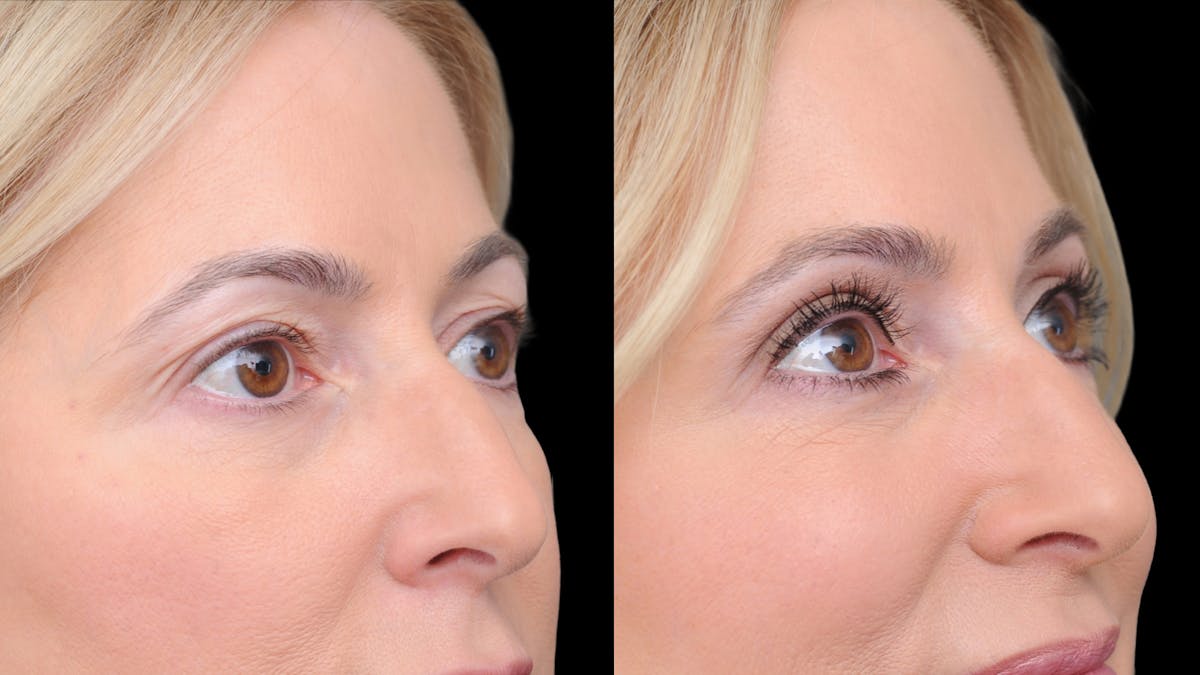 Upper Eyelid Surgery Before & After Gallery - Patient 152989 - Image 7