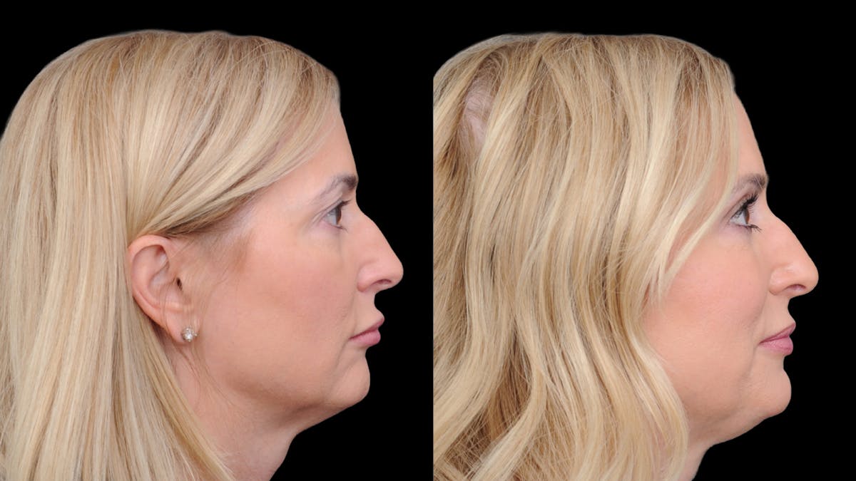 Upper Eyelid Surgery Before & After Gallery - Patient 152989 - Image 8