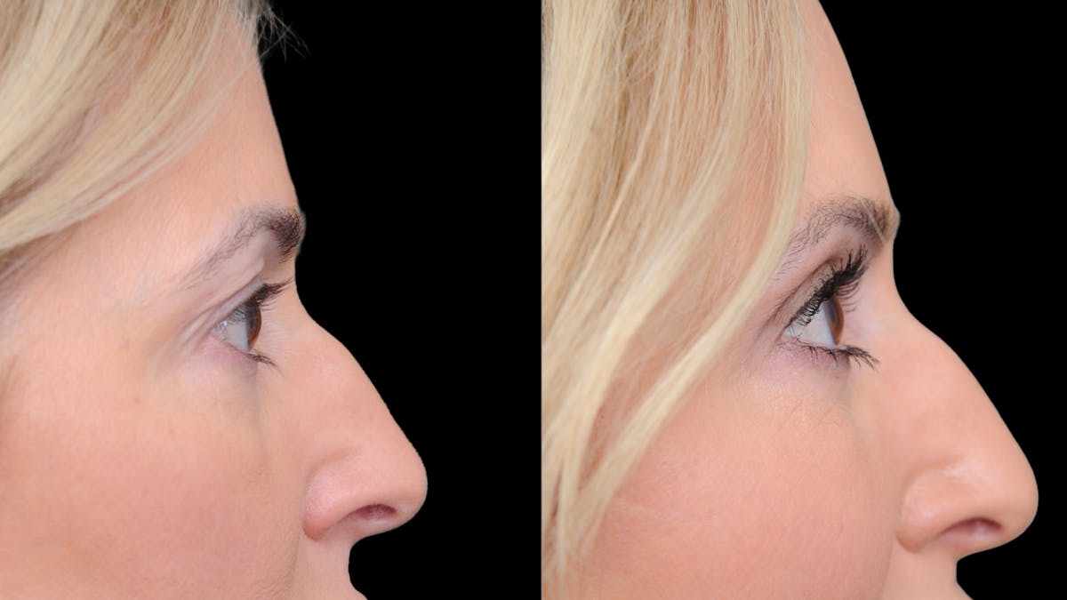 Upper Eyelid Surgery Before & After Gallery - Patient 152989 - Image 9