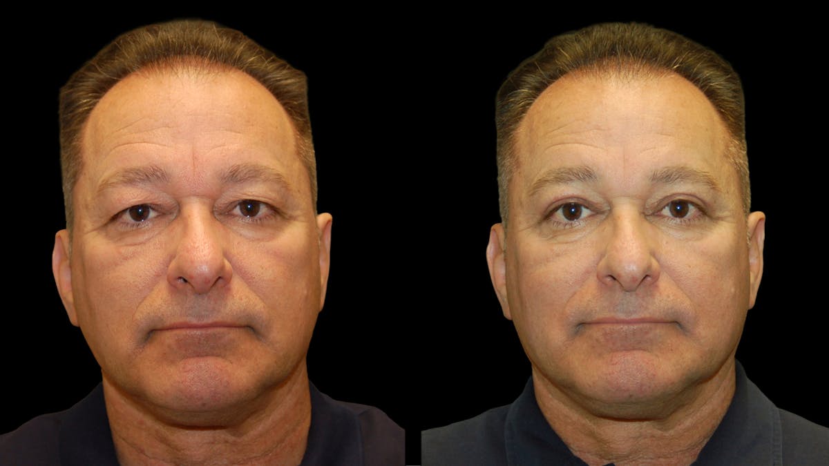 Upper Eyelid Surgery Before & After Gallery - Patient 318209 - Image 1