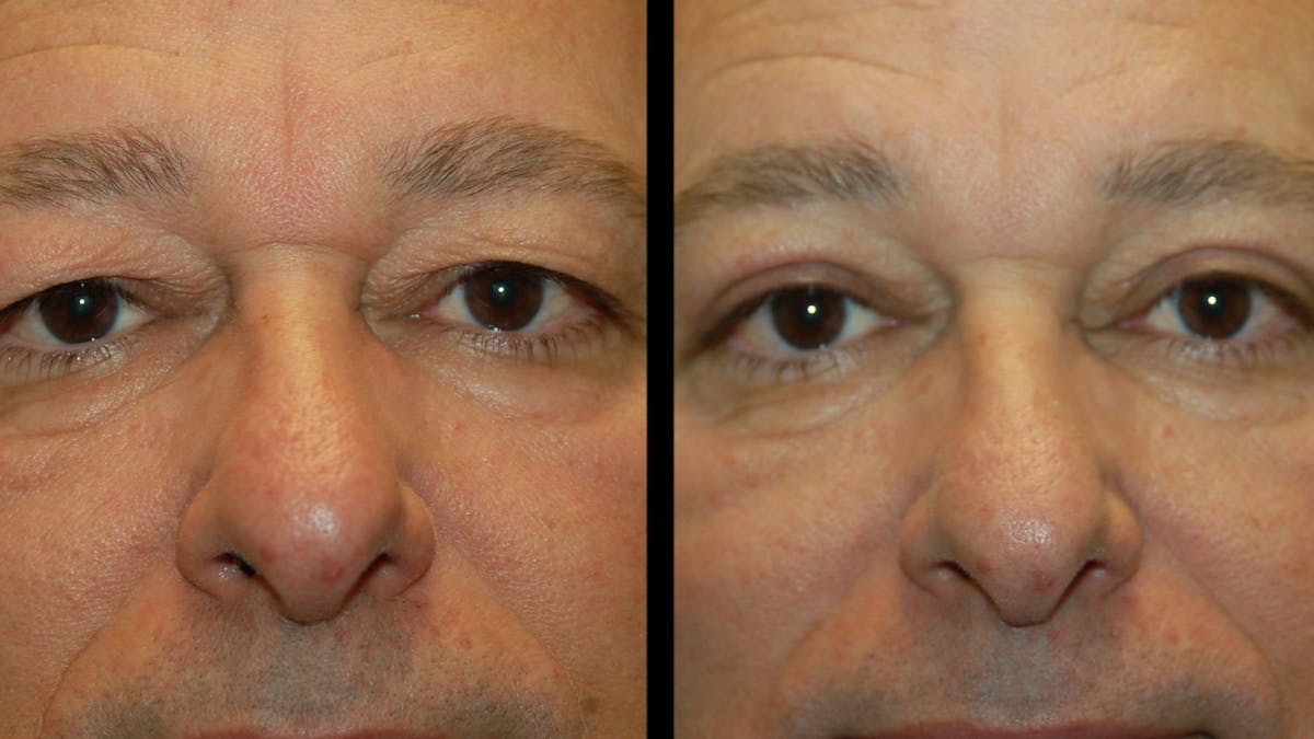 Upper Eyelid Surgery Before & After Gallery - Patient 318209 - Image 2