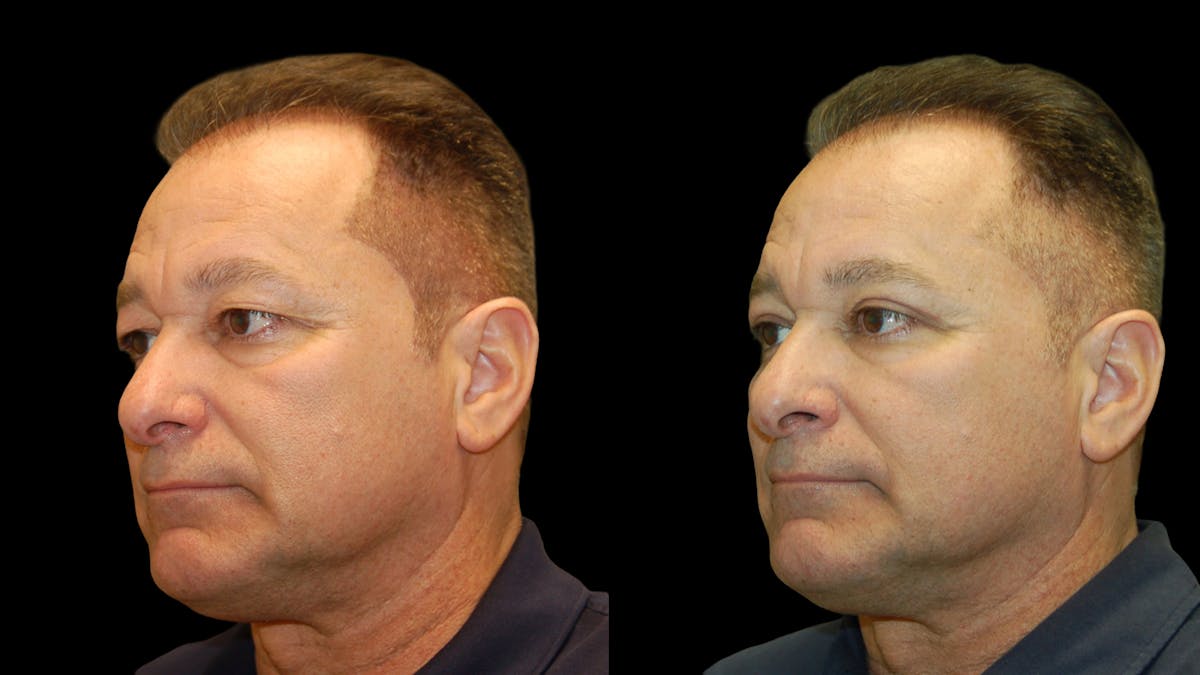 Upper Eyelid Surgery Before & After Gallery - Patient 318209 - Image 3