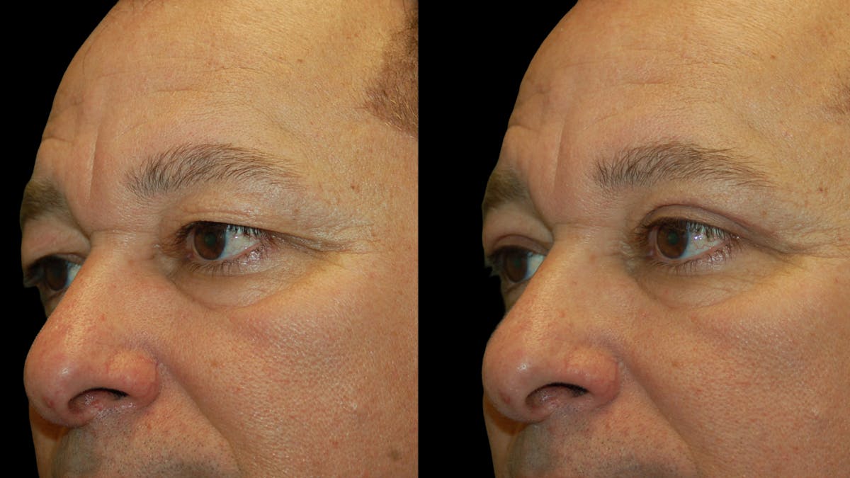 Upper Eyelid Surgery Before & After Gallery - Patient 318209 - Image 4