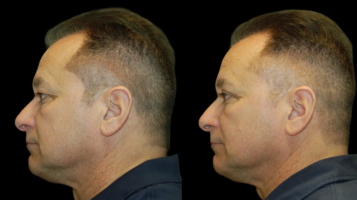 Upper Eyelid Surgery Before & After Gallery - Patient 318209 - Image 5