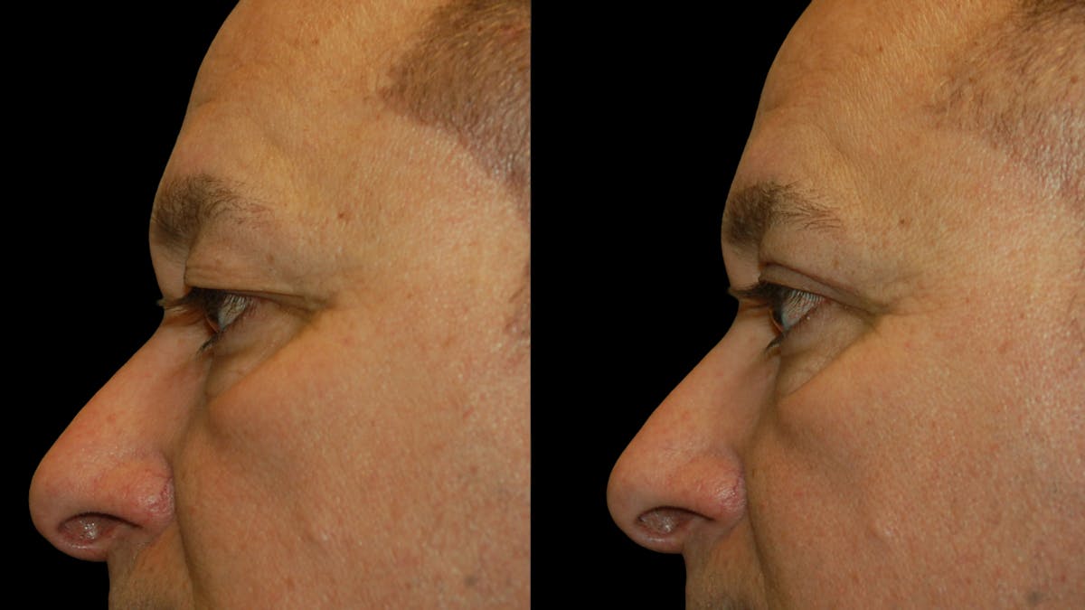 Upper Eyelid Surgery Before & After Gallery - Patient 318209 - Image 6