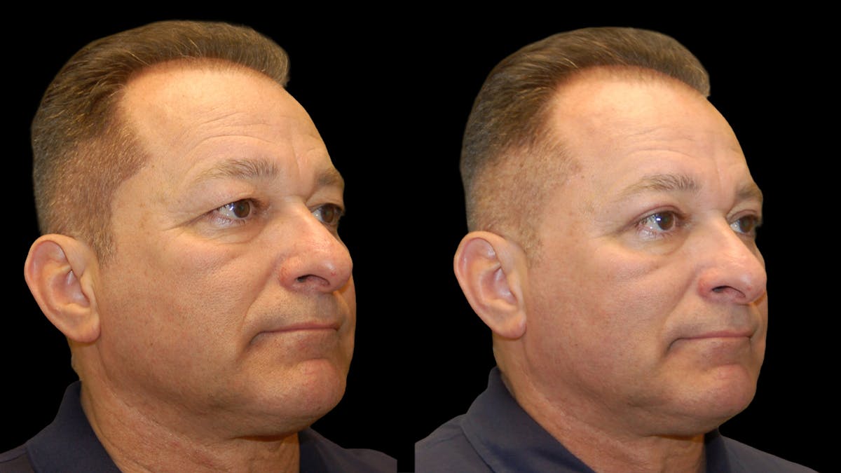 Upper Eyelid Surgery Before & After Gallery - Patient 318209 - Image 7