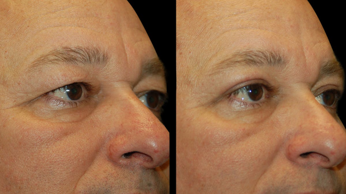 Upper Eyelid Surgery Before & After Gallery - Patient 318209 - Image 8
