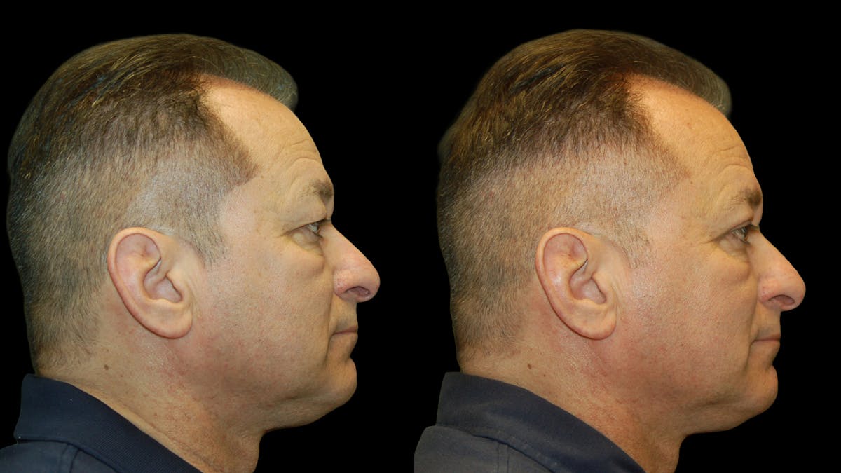 Upper Eyelid Surgery Before & After Gallery - Patient 318209 - Image 9