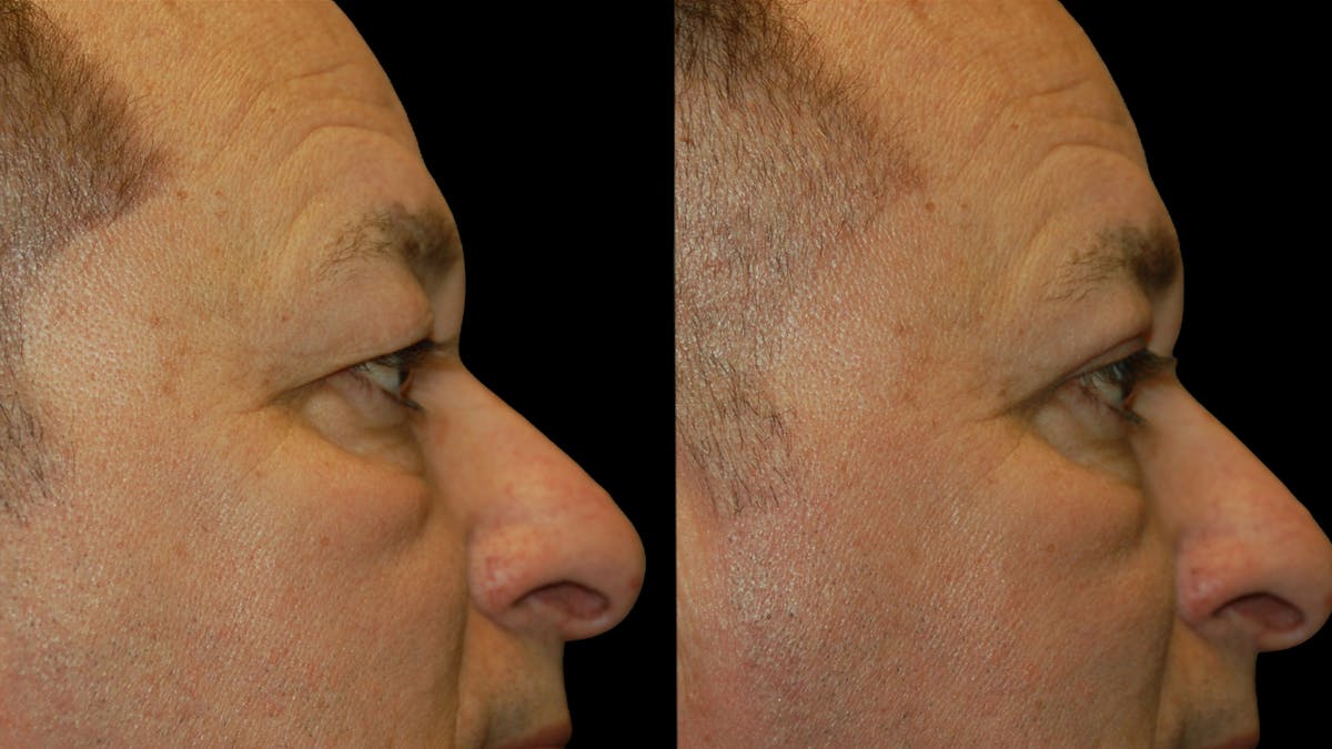 Upper Eyelid Surgery Before & After Gallery - Patient 318209 - Image 10