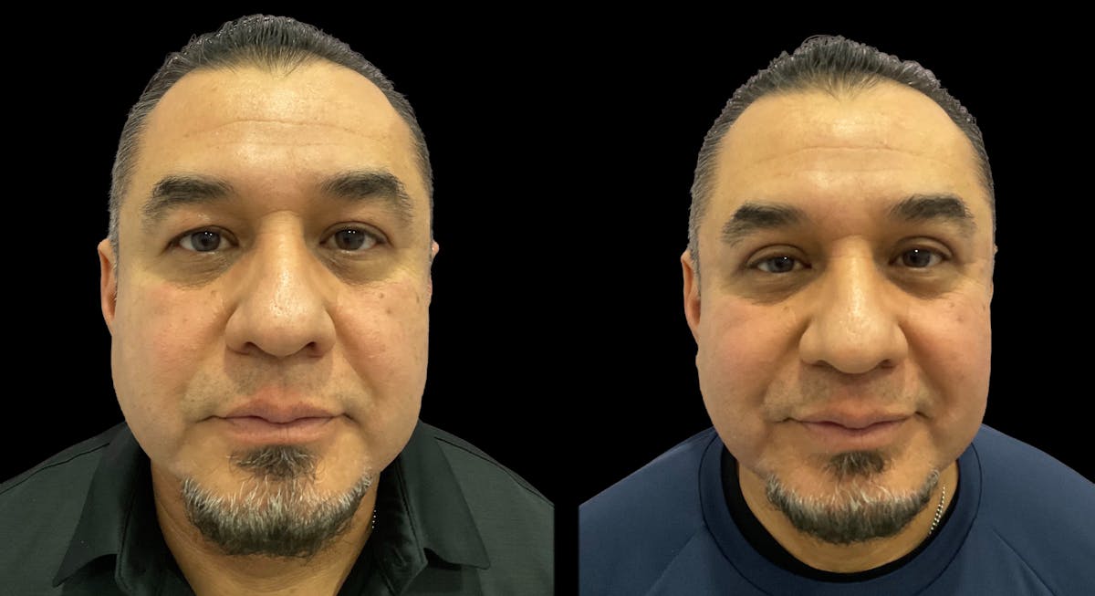 Upper Eyelid Surgery Before & After Gallery - Patient 365049 - Image 1