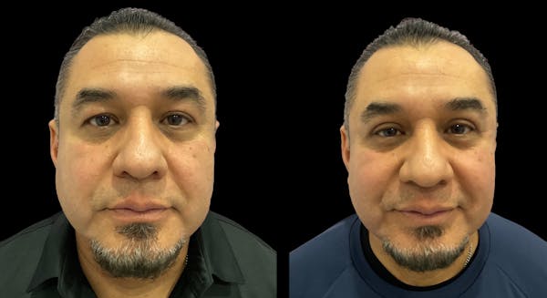 Upper Eyelid Surgery Before & After Gallery - Patient 365049 - Image 1