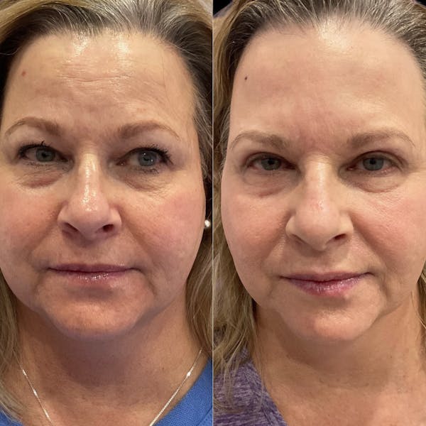 Upper Eyelid Surgery Before & After Gallery - Patient 412208 - Image 1