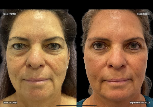 Upper Eyelid Surgery Before & After Gallery - Patient 425418 - Image 1