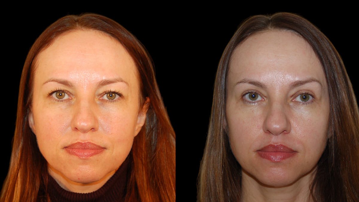 Upper Eyelid Surgery Before & After Gallery - Patient 160026 - Image 1