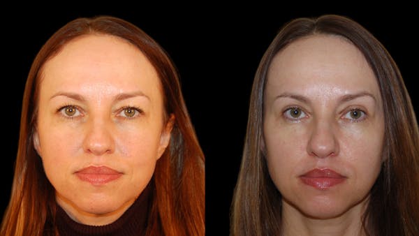 Upper Eyelid Surgery Before & After Gallery - Patient 160026 - Image 1