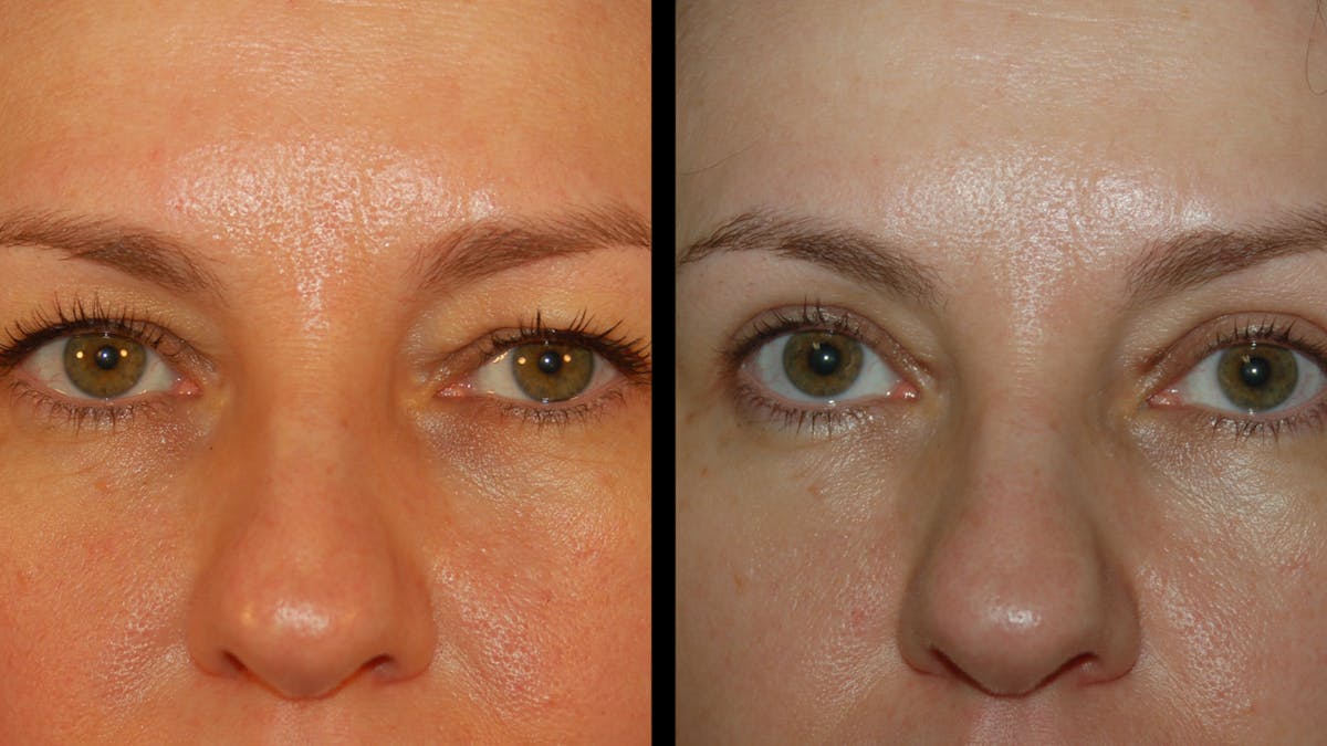Upper Eyelid Surgery Before & After Gallery - Patient 160026 - Image 2