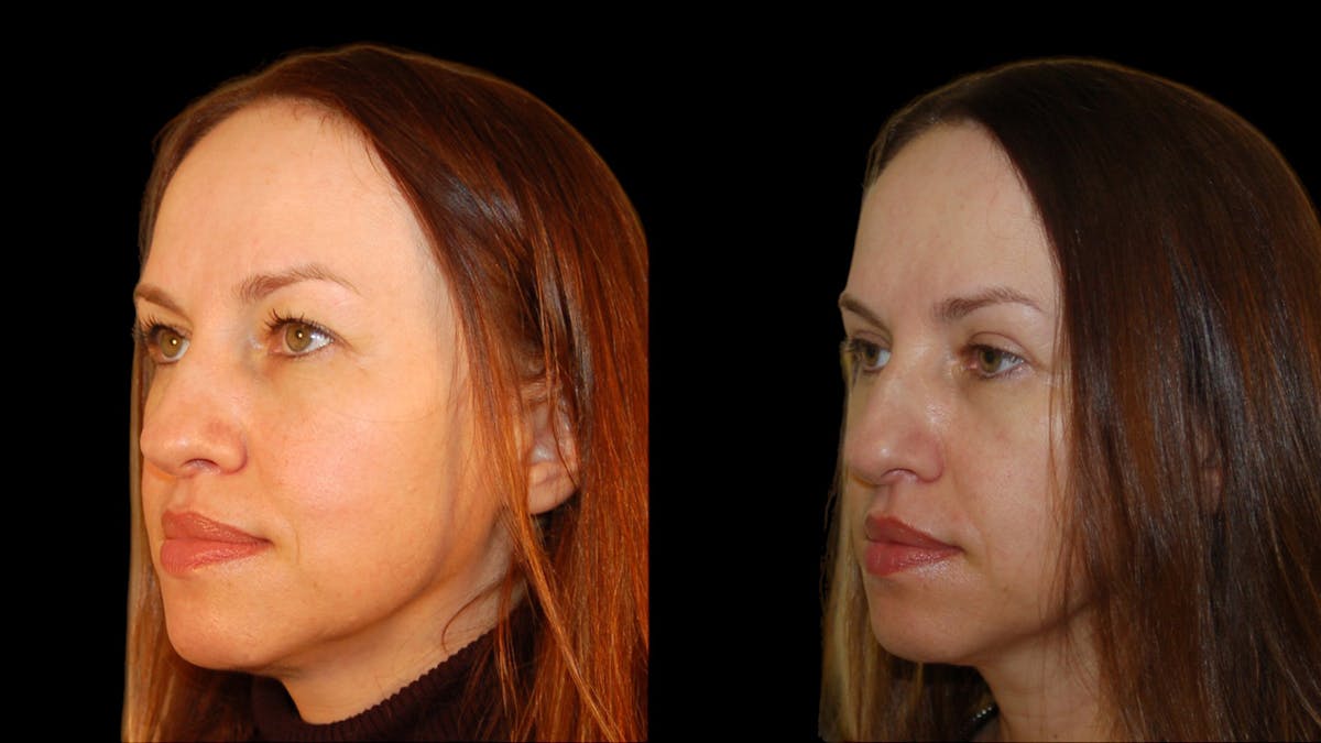 Upper Eyelid Surgery Before & After Gallery - Patient 160026 - Image 3