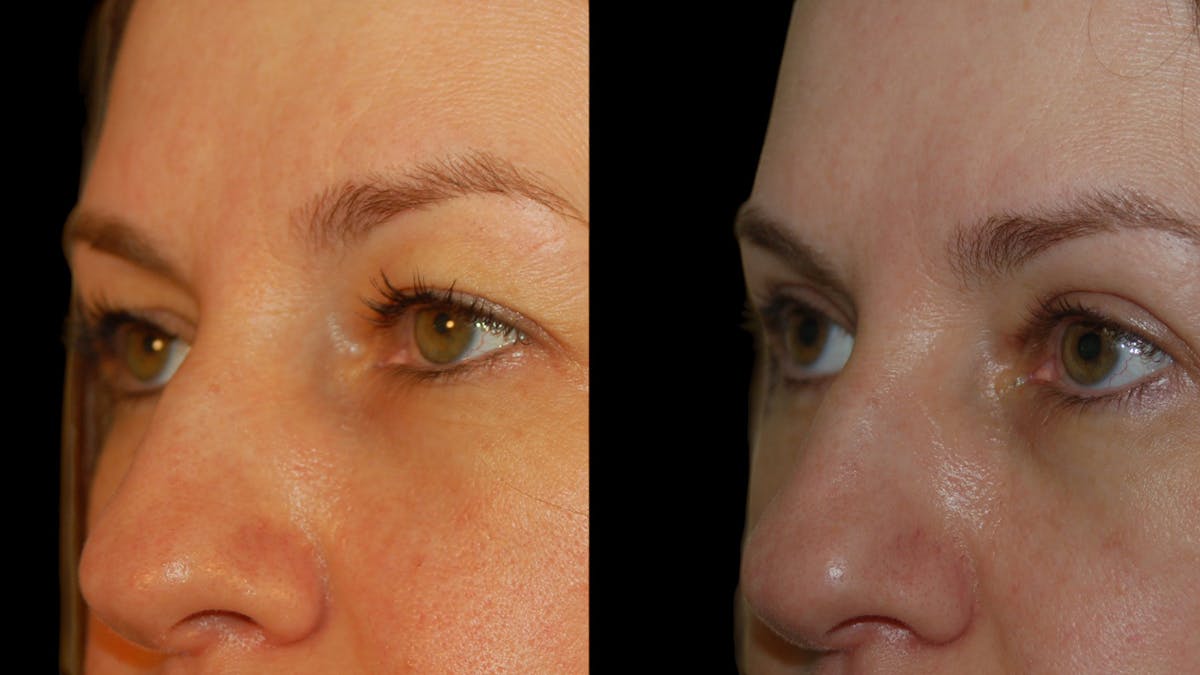 Upper Eyelid Surgery Before & After Gallery - Patient 160026 - Image 4