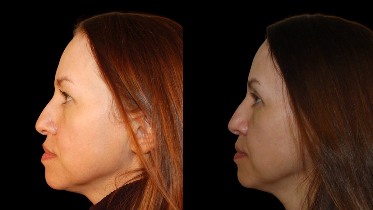 Upper Eyelid Surgery Before & After Gallery - Patient 160026 - Image 5