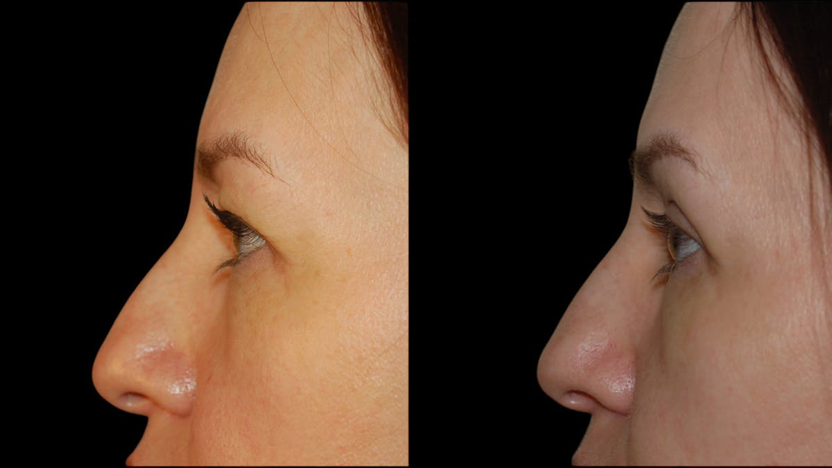 Upper Eyelid Surgery Before & After Gallery - Patient 160026 - Image 6