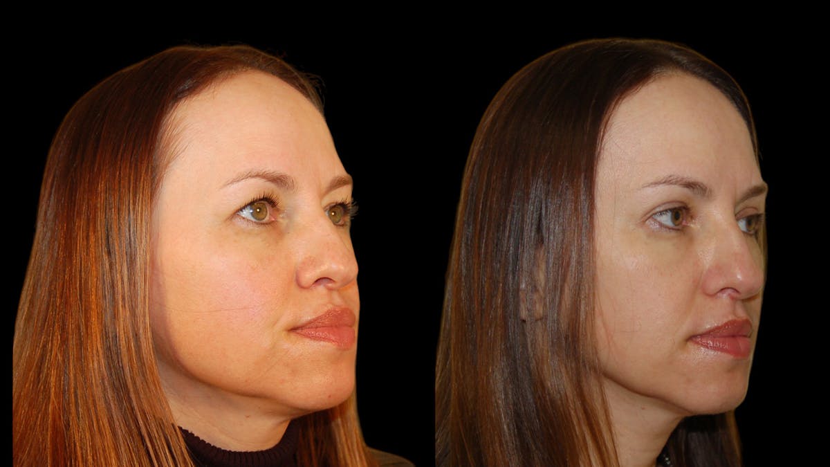Upper Eyelid Surgery Before & After Gallery - Patient 160026 - Image 7