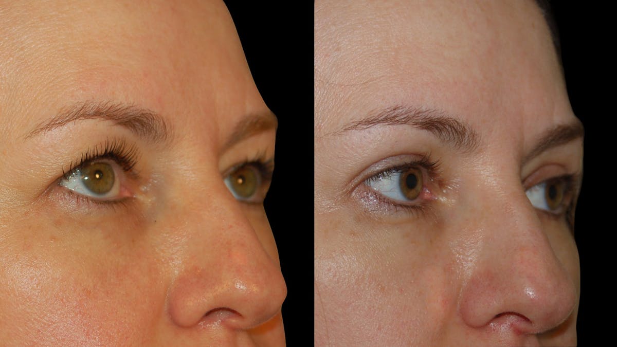 Upper Eyelid Surgery Before & After Gallery - Patient 160026 - Image 8