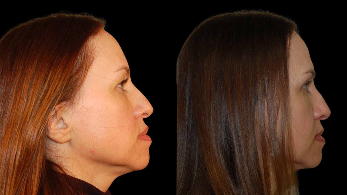 Upper Eyelid Surgery Before & After Gallery - Patient 160026 - Image 9