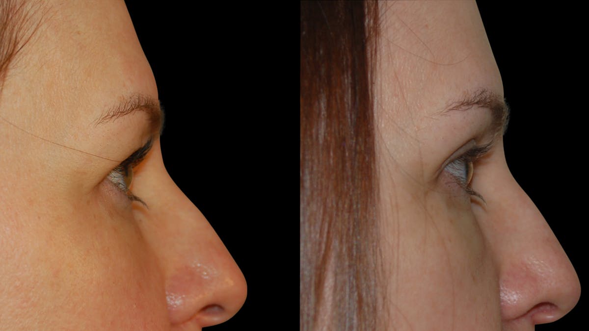 Upper Eyelid Surgery Before & After Gallery - Patient 160026 - Image 10