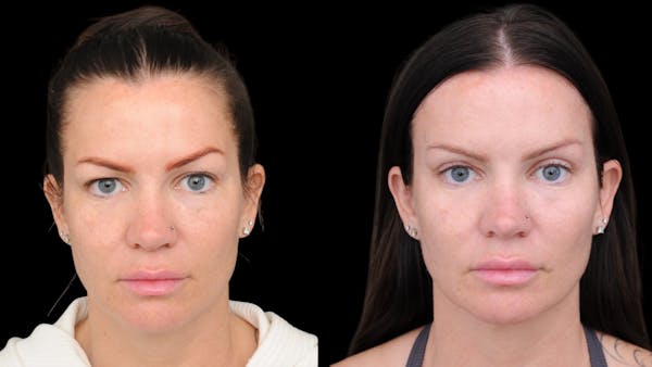 Upper Eyelid Surgery Before & After Gallery - Patient 199450 - Image 1