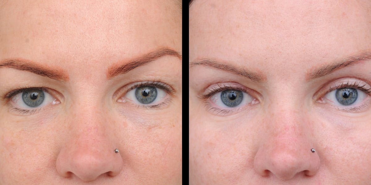 Upper Eyelid Surgery Before & After Gallery - Patient 199450 - Image 2