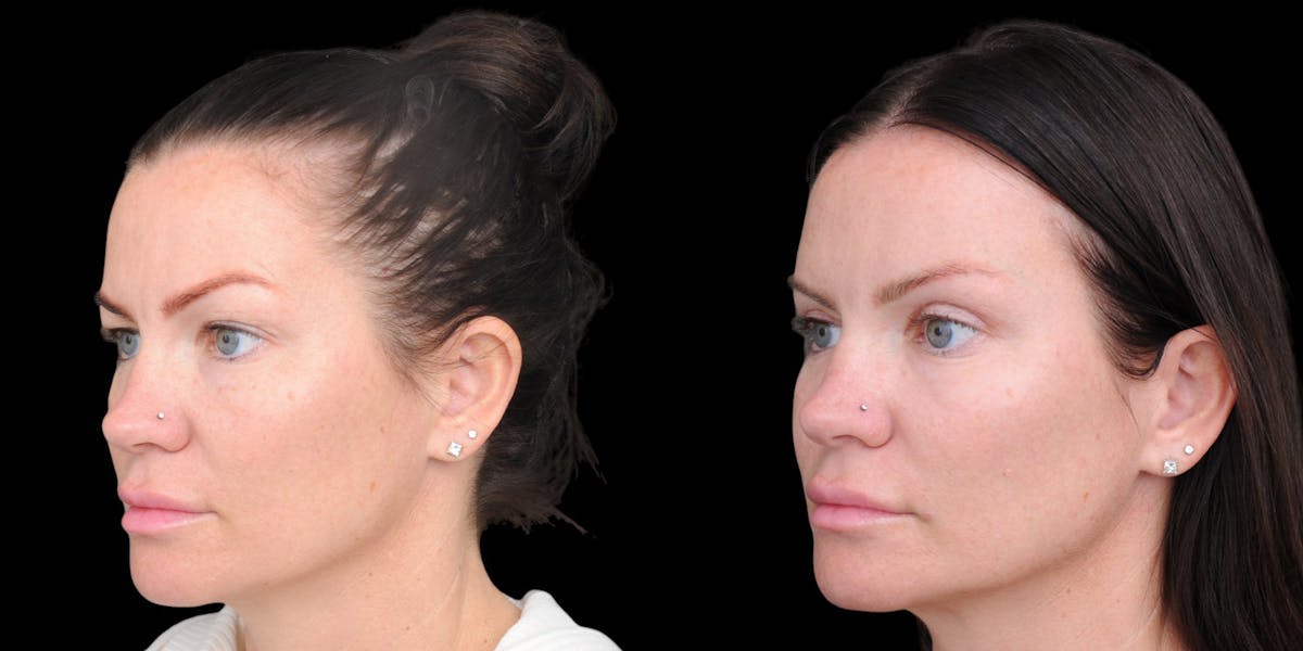 Upper Eyelid Surgery Before & After Gallery - Patient 199450 - Image 3