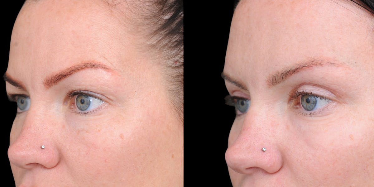 Upper Eyelid Surgery Before & After Gallery - Patient 199450 - Image 4