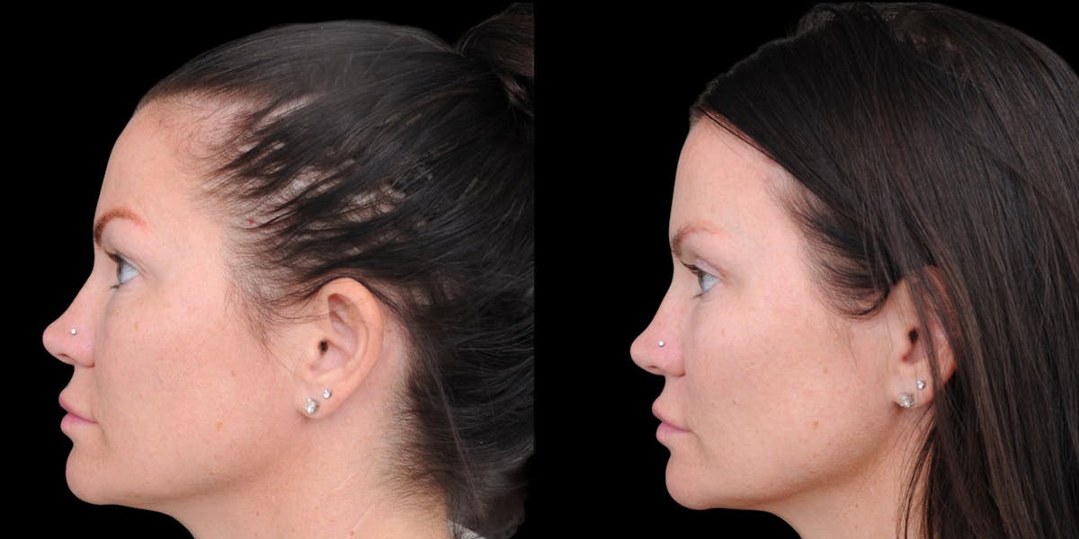 Upper Eyelid Surgery Before & After Gallery - Patient 199450 - Image 5