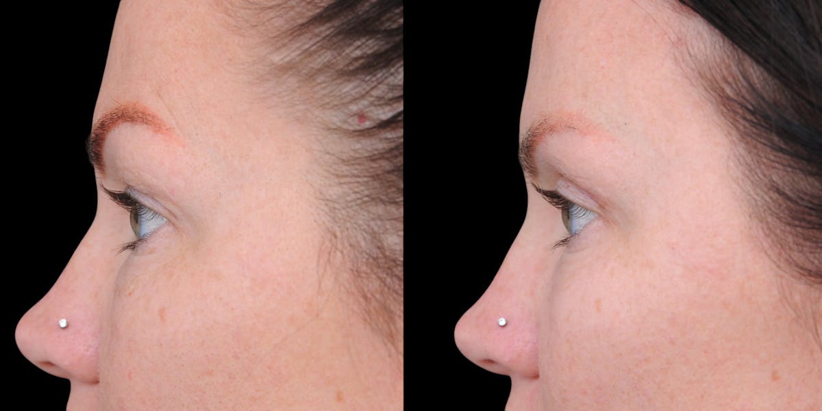 Upper Eyelid Surgery Before & After Gallery - Patient 199450 - Image 6