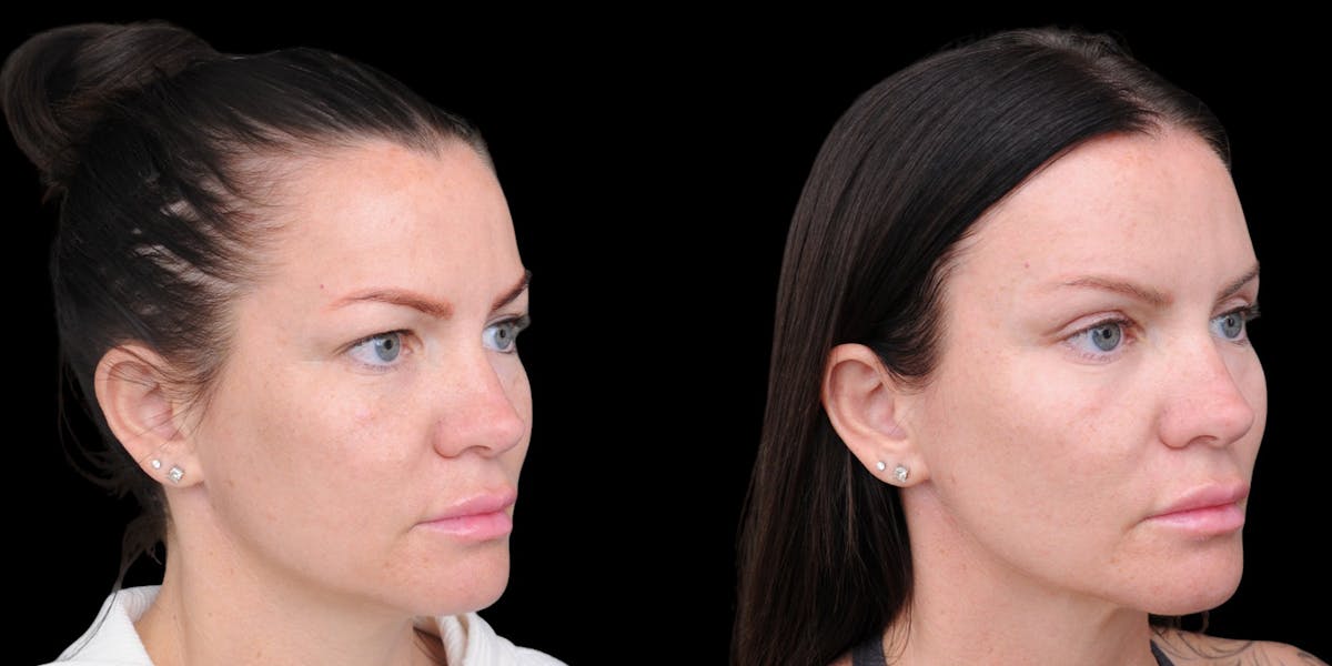 Upper Eyelid Surgery Before & After Gallery - Patient 199450 - Image 7