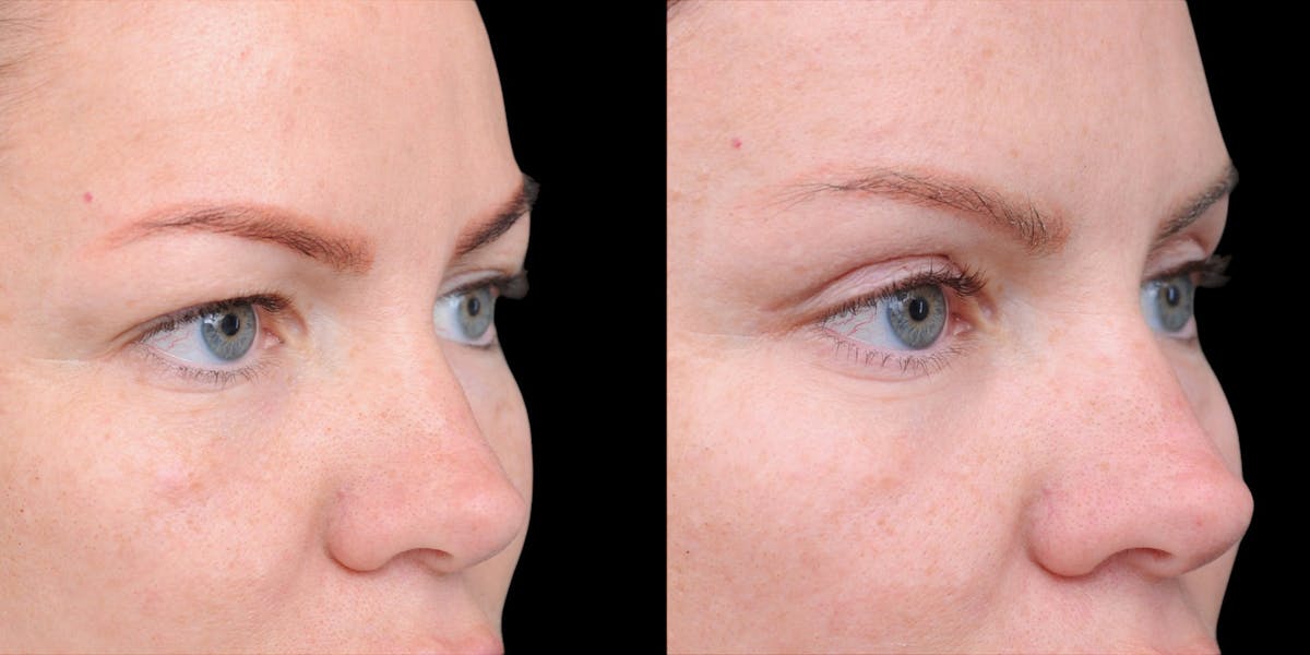 Upper Eyelid Surgery Before & After Gallery - Patient 199450 - Image 8