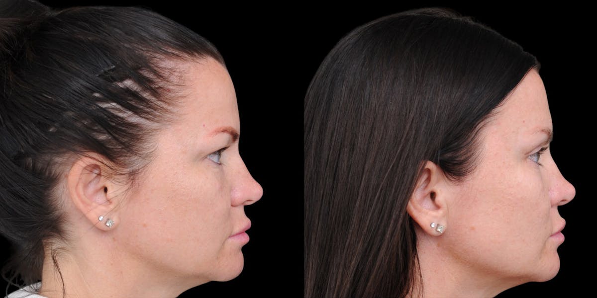 Upper Eyelid Surgery Before & After Gallery - Patient 199450 - Image 9