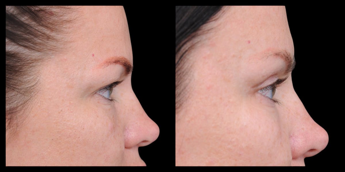 Upper Eyelid Surgery Before & After Gallery - Patient 199450 - Image 10