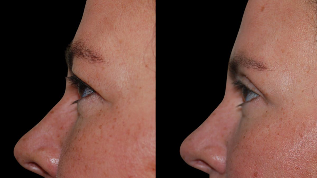 Upper Eyelid Surgery Before & After Gallery - Patient 855219 - Image 2