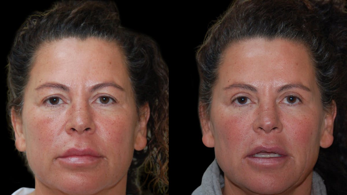 Upper Eyelid Surgery Before & After Gallery - Patient 855219 - Image 3