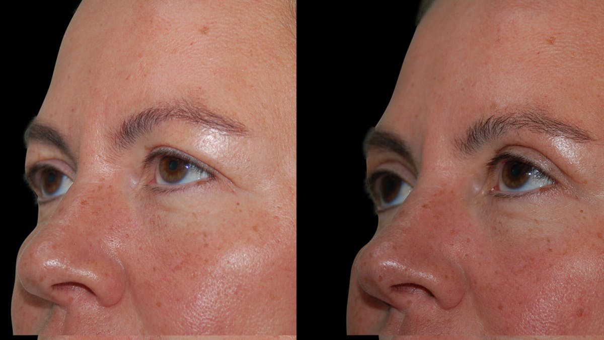 Upper Eyelid Surgery Before & After Gallery - Patient 855219 - Image 1
