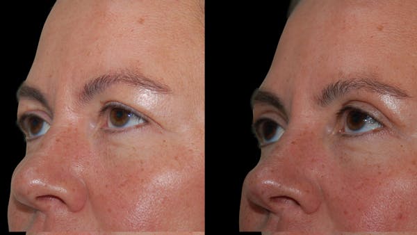 Upper Eyelid Surgery Before & After Gallery - Patient 855219 - Image 1