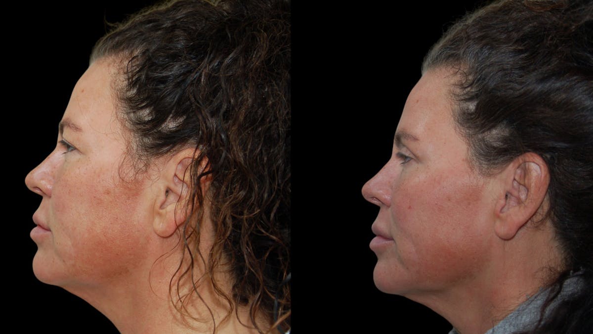 Upper Eyelid Surgery Before & After Gallery - Patient 855219 - Image 4