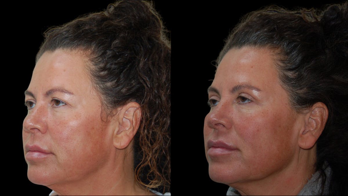 Upper Eyelid Surgery Before & After Gallery - Patient 855219 - Image 5
